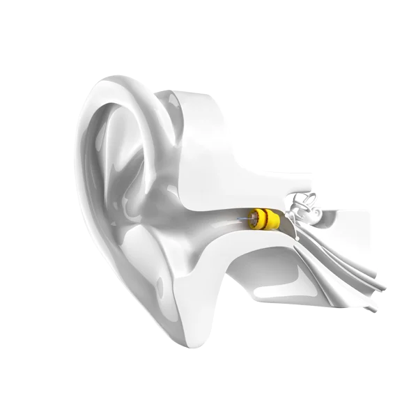 Phonak Lyric — view 1